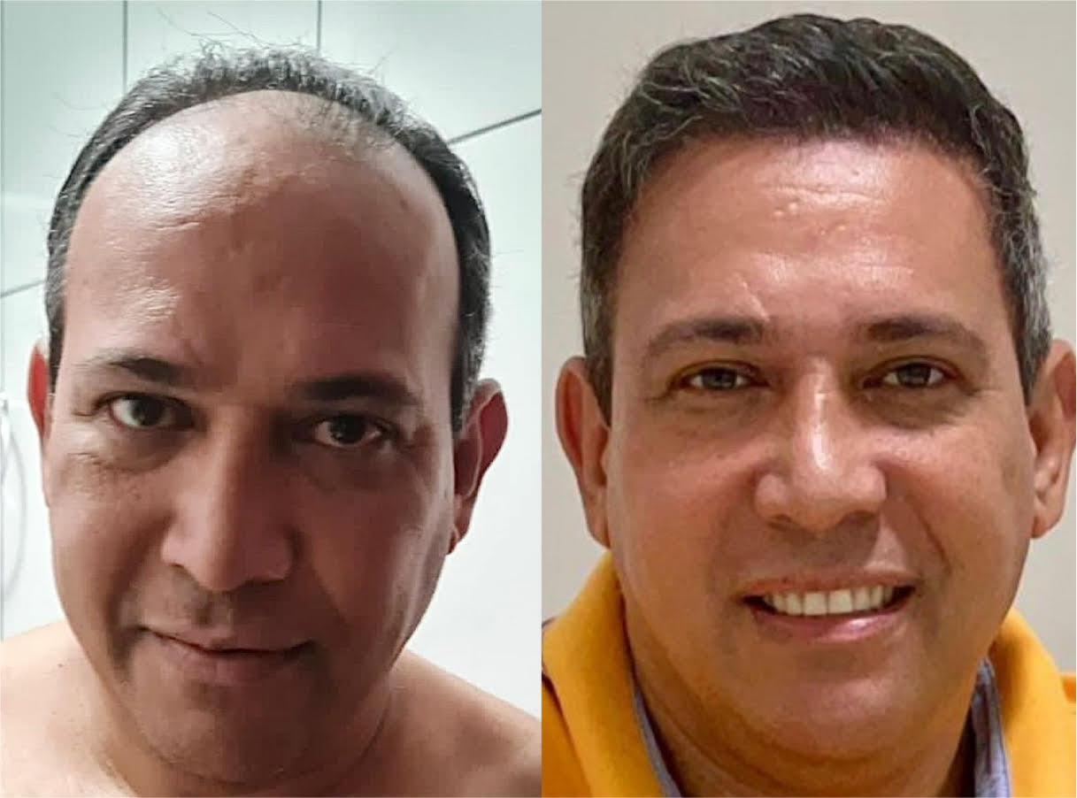 foto de resultado antes e depois de transplante capilar